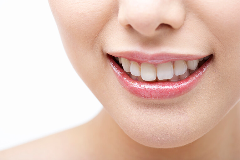 銀歯からセラミックの白い歯にするメリット
