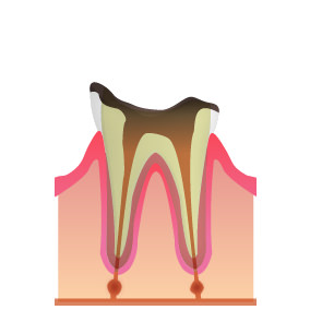 C4~歯根の虫歯