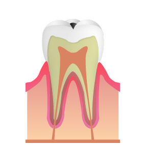 C1~エナメル質
（歯の表面）の虫歯