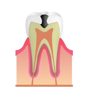 C2~象牙質
（エナメル質の内側）の虫歯
